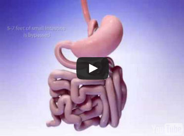 Mini gastric bypass surgery
