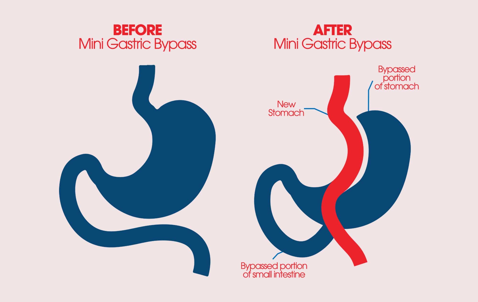 Preparing for metabolic surgery